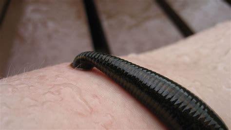 Medical Leech Therapy