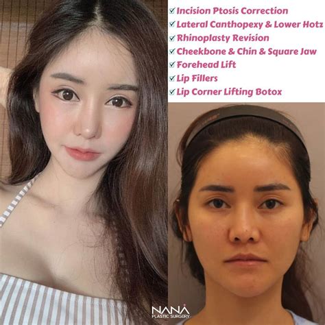 Korean Plastic Surgery Jaw Shaving - Inspiring Your Life