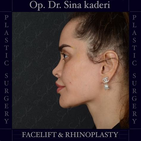 Deep Plane Facelift and Closed Piezo Rhinoplasty: Redefining the ...