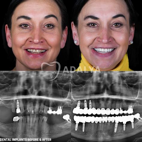 Dental Implants Before and After: Pictures & All Guideline