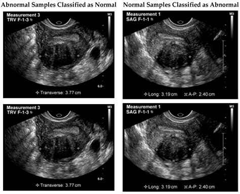 Automated Uterine Fibroids Detection in Ultrasound Images Using Deep Convolutional Neural Networks