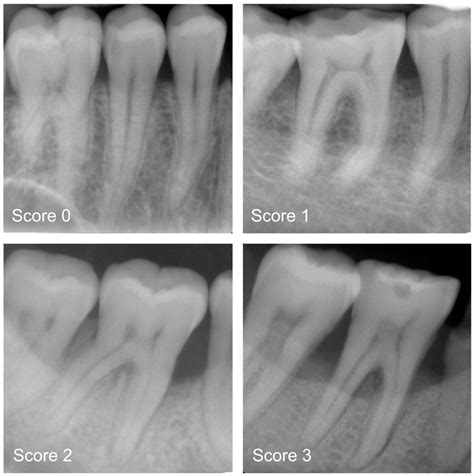 Alveolar Bone Loss PDF] Are Panoramic Radiographs Reliable To Diagnose