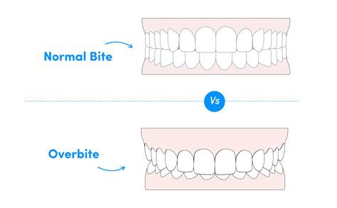 Normal Bite Vs Overbite