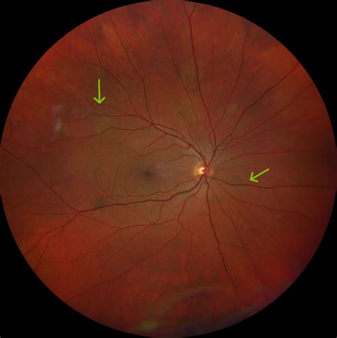 Neurofibromatosis with multiple bilateral choroidal nevi and literature review | Eye News