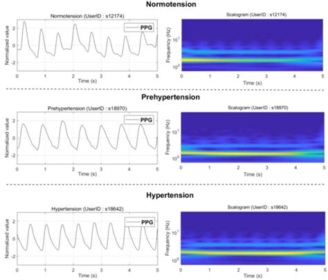 Photoplethysmography and Deep Learning: Enhancing Hypertension Risk ...