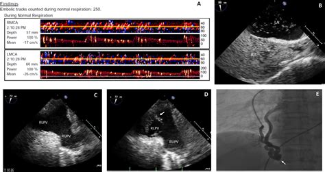 Pearls and Pitfalls in the Transesophageal Echocardiographic Diagnosis ...