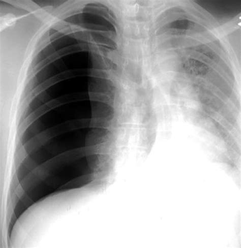Right Pneumothorax X Ray