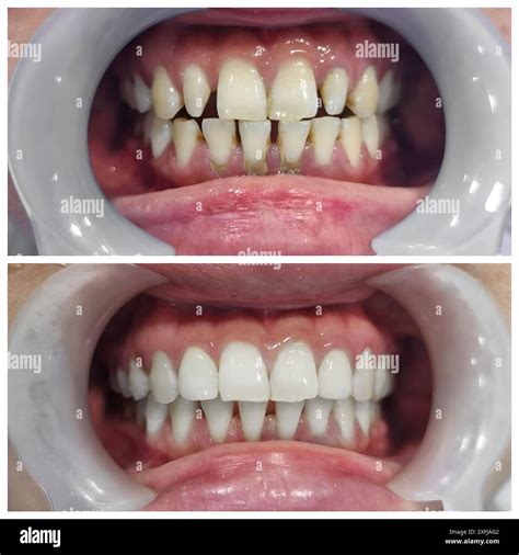 Before and after treatment of large gap between the front teeth called diastema Stock Photo - Alamy