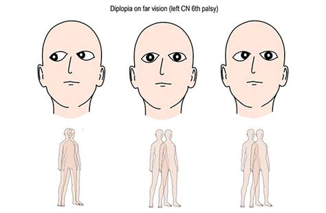 Hemifacial Spasm: Causes, Symptoms, and Treatments