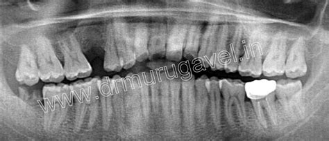 » Painless Dental Implant with Computerized Anesthesia in India