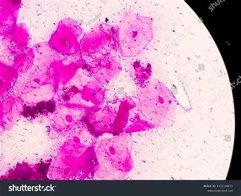 Bacterial Vaginosis Clue Cells Bacterial Vaginosis