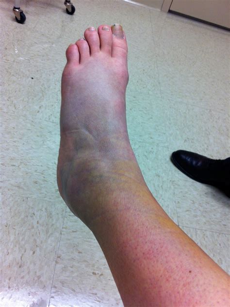 Diary of a Running Mom: latest and greatest ankle injury pictures