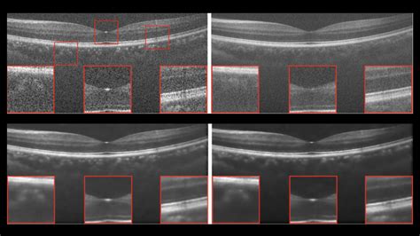 Medical Image Processing @ CVIT, IIIT Hyderabad