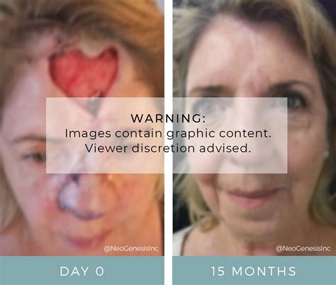 Basal Cell Carcinoma Cancer Surgery Before + After Photos