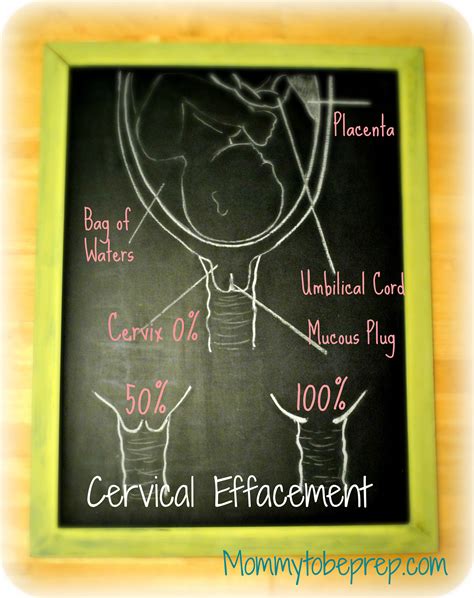 Cervical Effacement Dilation Cervical Effacement Cervix Dilation