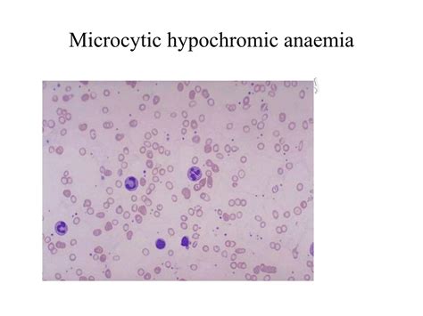 Anemia, Microcytic Hypochromic and Macrocytic anemia | PPT