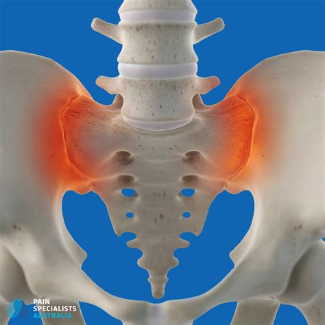Sacroiliac Joint Pain Treatment in Melbourne — Pain Specialists Australia