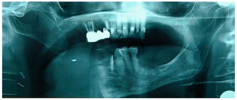 Functional Rehabilitation in Non-Reconstructed Hemimandibulectomy Patients