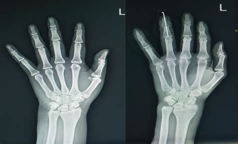 Right Hand X Ray Normal