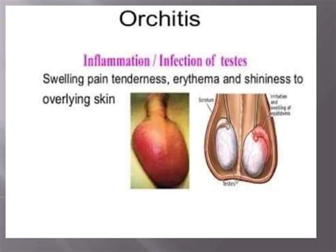 Orchitis and Urinary tract infection Dr Shahid.pptx