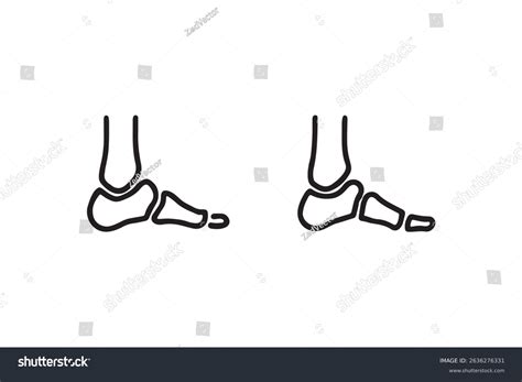 7 Flat Feet Vs Normal Feet Royalty-Free Images, Stock Photos & Pictures ...