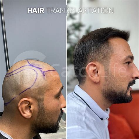 Hair Transplant Turkey - Hair Transplant Packages Price