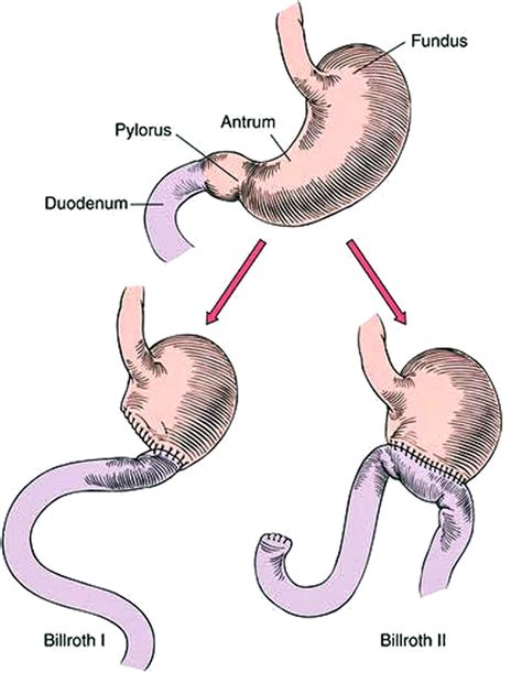 Post-Surgical Anatomy and ERCP - Techniques in Gastrointestinal Endoscopy