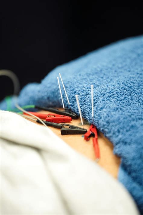 How Does Dry Needling Work Physical Therapy at Sandra Wells blog