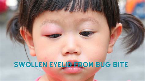 Effective Remedies and Prevention for Swollen Eyelids Caused by Bug ...