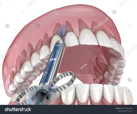 Local Anesthesia Cartoon 的图像结果