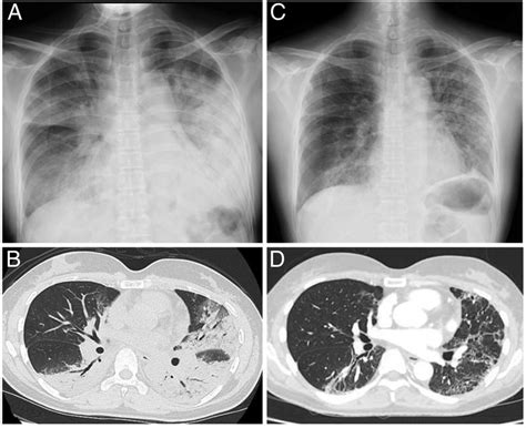 Paradoxical respiration: ‘Seesaw’ motion with massive pulmonary consolidation | BMJ Case Reports