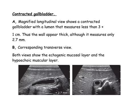 Gall bladder Ultrasound | PPT