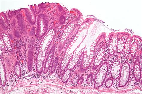 What Is Tubular Adenoma