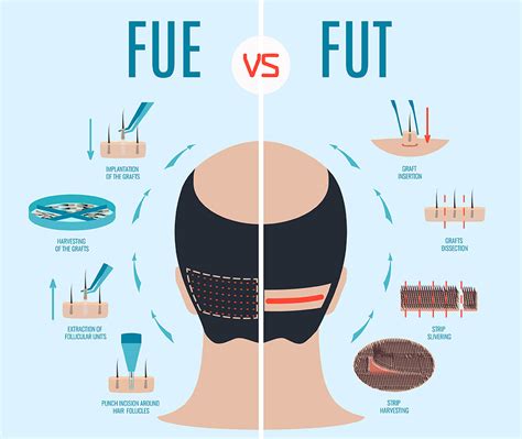 Traditional and Modern Hair Transplant In Malaysia (FUE and FUT ...