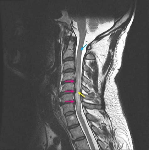Spinal Cord Compression - Spinal Cord Compression - MSD Manual ...