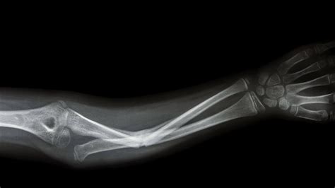Graphene Shows Promise for Repairing Broken Bones