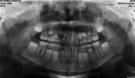 Epidermoid carcinoma of the oral cavity in pediatric age. Apropos of a case. Review of the ...