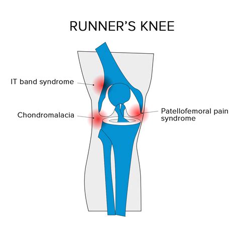 Pain Behind Knee After Running Treatment at Fred Ford blog