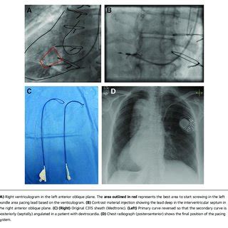 Image result for Installing Pacemaker