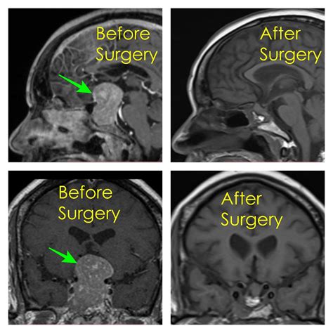 After Pituitary Tumor Removal