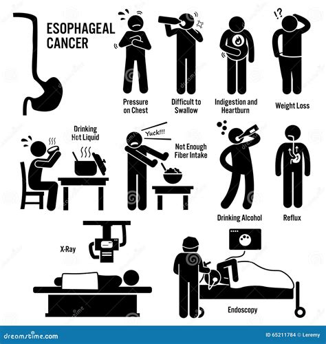 Esophageal Esophagus Throat Cancer Clipart Stock Vector - Illustration of diagnosis, oncology ...
