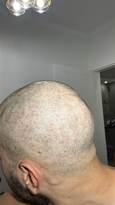 Gram-Negative Folliculitis Contagious? : r/Folliculitis
