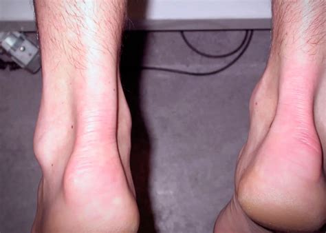 Tratamiento fisioterapéutico para Calcificación tendón de aquiles ...