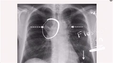 Chest X Ray Pulmonary Embolism