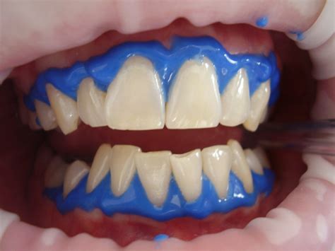 How to Treat Sensitive Teeth After Tooth Whitening - My Dentist Hub