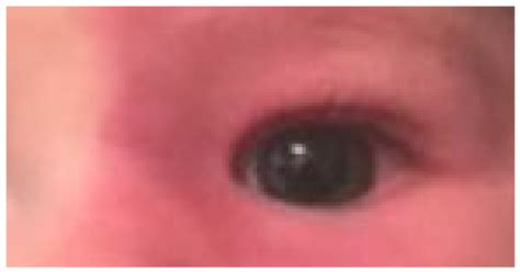 Primary Congenital and Childhood Glaucoma—A Complex Clinical Picture ...