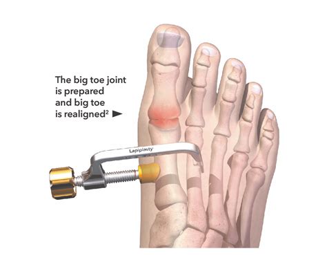 First Toe Replacement Surgery _ First Metatarsophalangeal Joint Fusion – IRMT