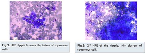 Locally Advanced Carcinoma Esophagus with Right Nipple Metastasis