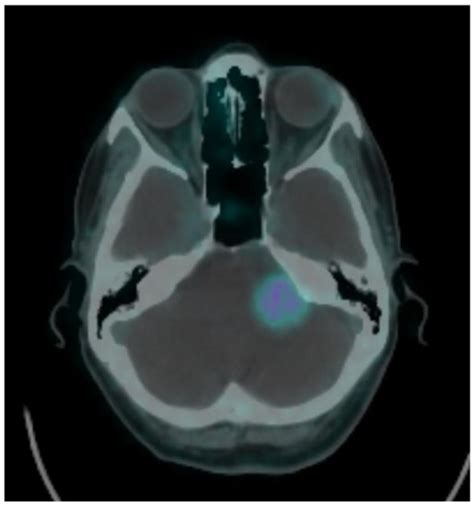 Brain Sciences | Special Issue : Modern Image-Guided Surgical ...
