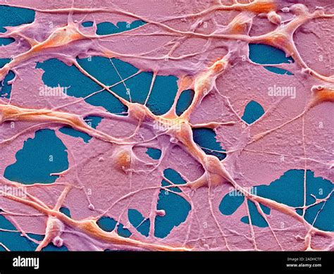 Teratoma cancer cells. Coloured scanning electron micrograph (SEM) of teratoma cancer cells. The ...
